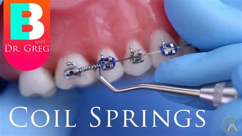 metal brackets act as springs buttons|Braces Explained – Jacksonville University School of Orthodontics.